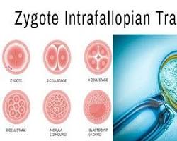ZIFT (zygote intrafallopian transfer) resmi