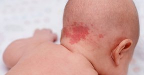 dogum-lekesi-cesitleri-nelerdir.jpg dogum-lekesi-cesitleri-nelerdir.jpg